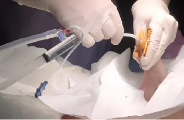 Catheter Release